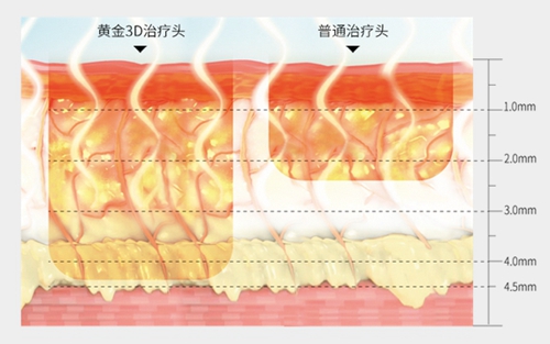 郑州东方整形*********第四代除皱