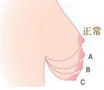 乳房下垂矫正手术中出现的形态异常应该怎么办