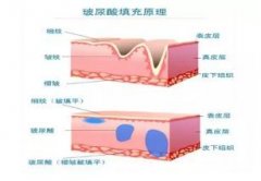 玻尿酸代谢之后皮肤会怎么样？