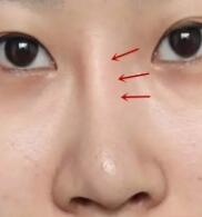 隆鼻术后，为什么会出現鼻子假体挪动、倾斜?