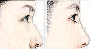 隆鼻术后的恢复期过程以及注意事项