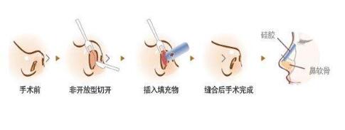 膨体隆鼻手术原理