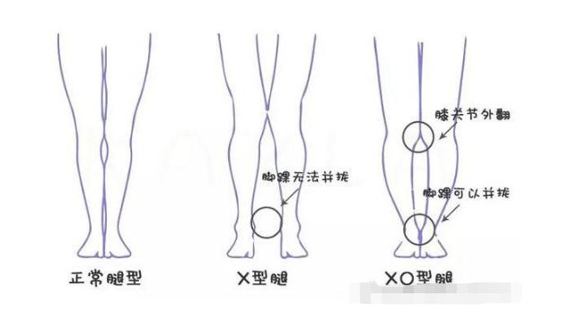 如何判断你是不是一个X形腿(也称为膝外翻)?