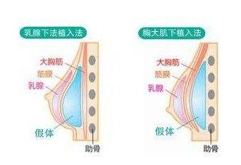 做完乳房假体植入手术之后的护理指导~