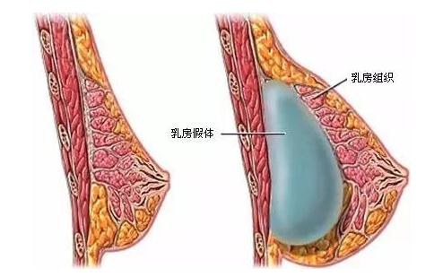 乳房假体植入手术之后的护理指导