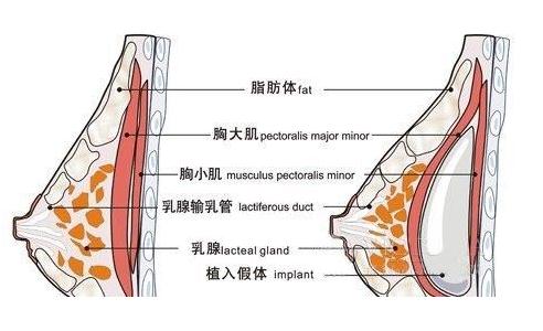 乳房植入假体的缺点