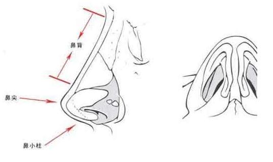假体隆鼻手术的过程