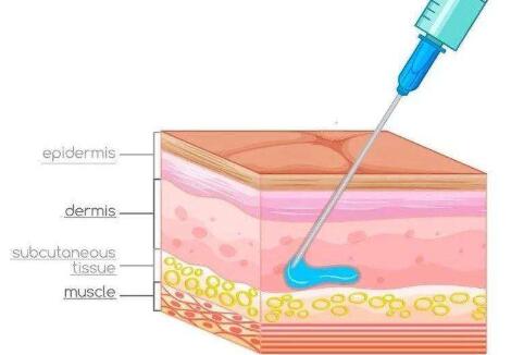 注射玻尿酸的注意事项