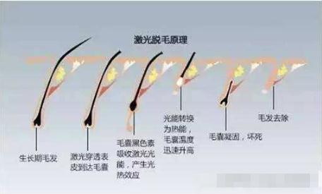 激光脱毛有果吗?