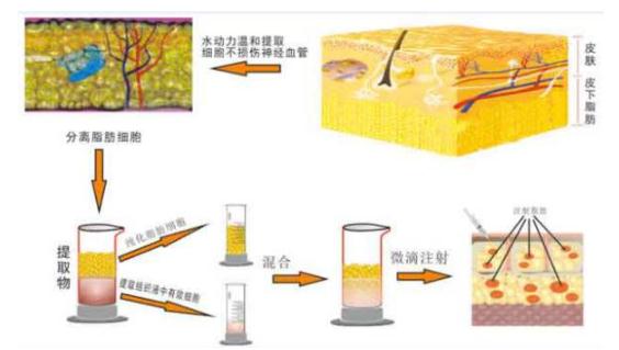 自体脂肪丰臀的优点