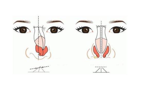 歪鼻矫正术的恢复期