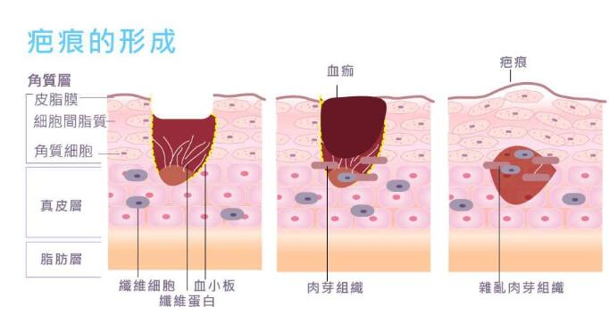 疤痕体质的注意事项