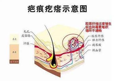 疤痕体质的注意事项