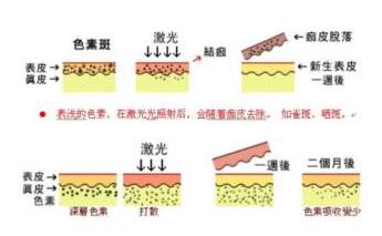 雀斑怎么回事？