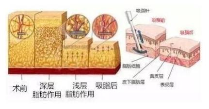 抽脂后不均匀主要与以下因素有关