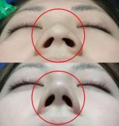 技术总结：手术缩小鼻子的方法有哪些？
