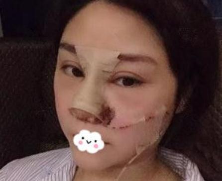 东莞韩美做的隆鼻修复手术术后第3天