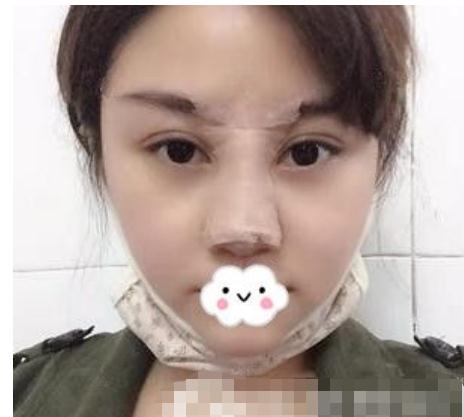 东莞韩美做的隆鼻修复手术术后第8天