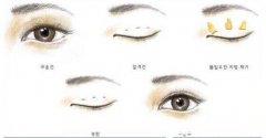 做韩式三点式双眼皮手术果能够维持多久？