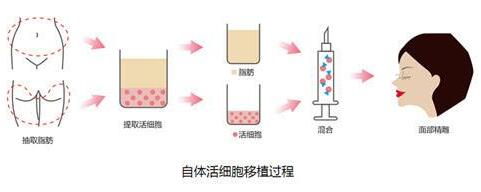 什么是自体脂肪面部填充？