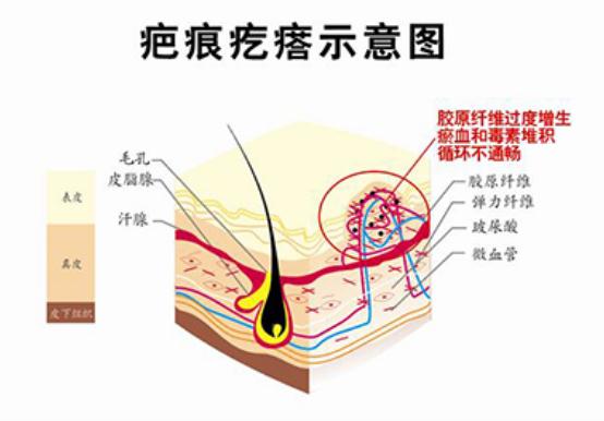 轻微瘢痕疙瘩需要调节？可以自愈吗？