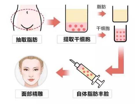 做自体脂肪丰额头需要做几次能够终身维持果?