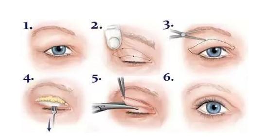 全切双眼皮术后3个月可以做修复手术了吗?