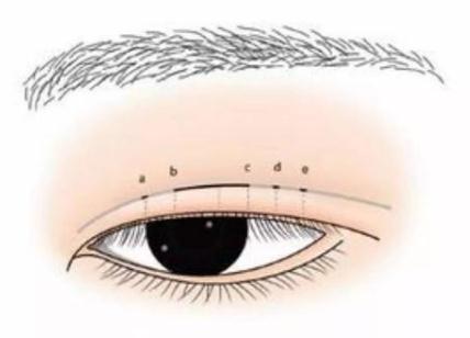割完双眼皮需要的注意事项