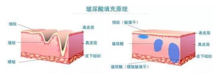 玻尿酸注射除皱的优势