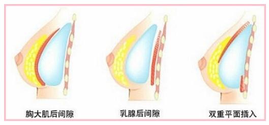 做假体隆胸的果可以维持多久?