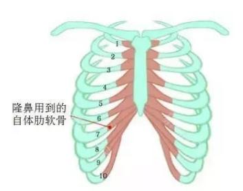 肋骨隆鼻原理