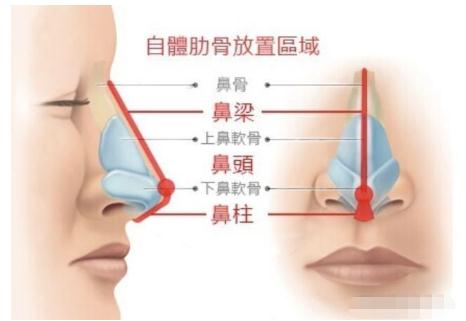 肋骨隆鼻后伤口多久能恢复呢?