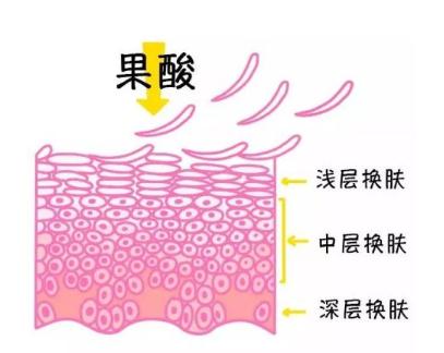 果酸焕肤主要是针对轻到中度的痤疮，具体机理如下：