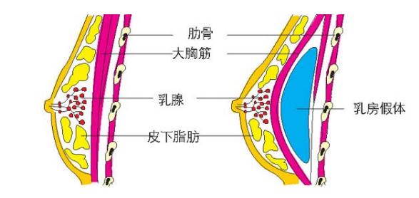 假体隆胸手术大概得要多少钱?