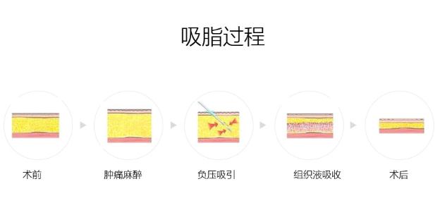 一般做腿部抽脂手术需要多少钱?