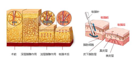 腰腹环吸是什么？