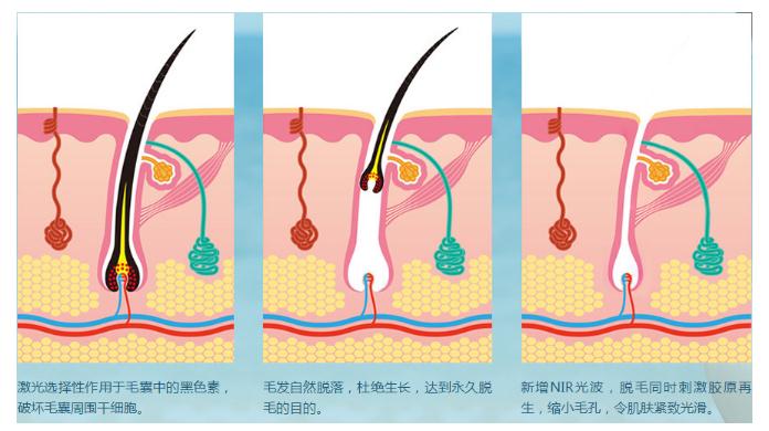 在整形美容机构做腋毛去除项目的果怎么样?