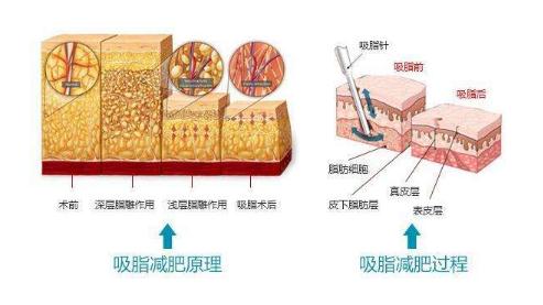 做完腰腹部吸脂之后，皮肤会不会变得松弛下垂？