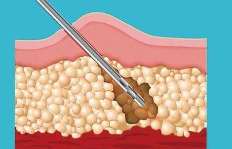 吸脂瘦臀的手术方式有哪些？这些技术须知！