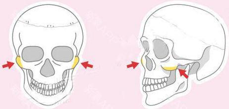 怎么磨颧骨？原来手术的过程是这样的！