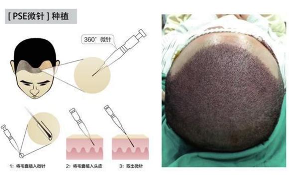 微创植发费用是受以下因素影响的