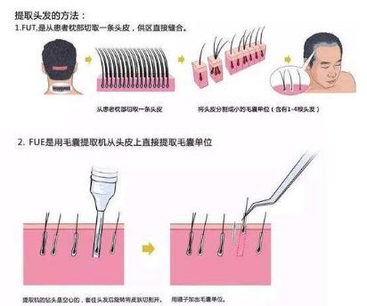 微创植发是不是真的微创呢?