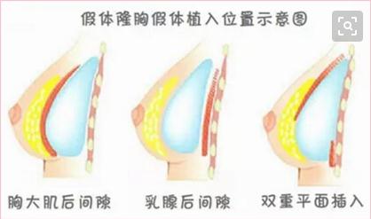 假体隆胸手术多久才能完全恢复？