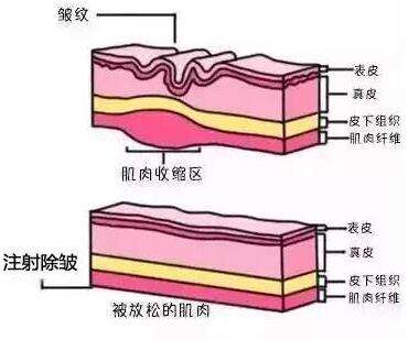 注射除皱使用玻尿酸和注射瘦脸原则上的区别！