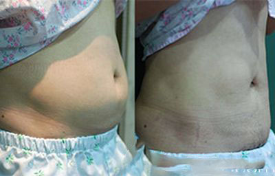 　韩国德克勒斯整形医院腰腹部吸脂术病例比较
