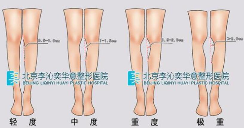 o型腿严重程度