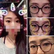 北京艺星祛眼袋手术案例，不到4000元轻松去掉眼袋微创迹！