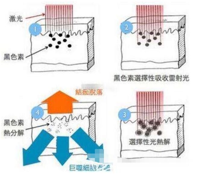 除了激光祛斑,这种方法祛斑对皮肤伤害更低!