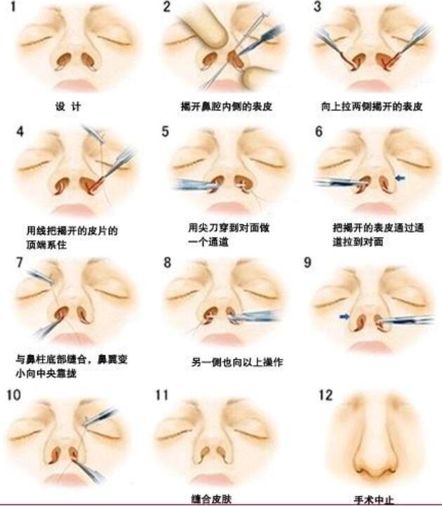 蒜头鼻整形手术步骤