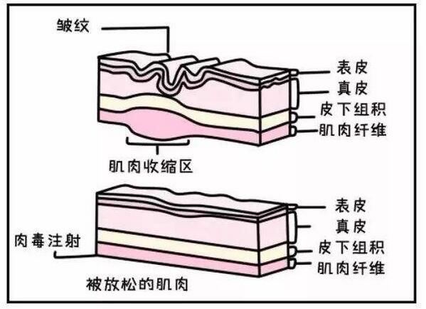 注射瘦脸除皱的原理图